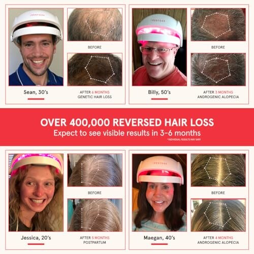Before and after hair loss treatment results for different individuals using a hair growth device.